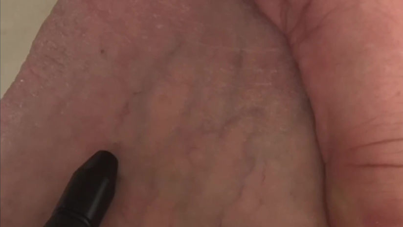 Spider veins treatment